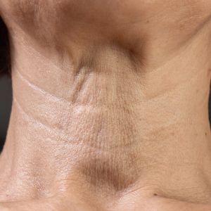 Nahaufnahme eines reifen Halses mit sichtbaren Hautfalten – Zeichen von Hautalterung im Dekolletébereich.