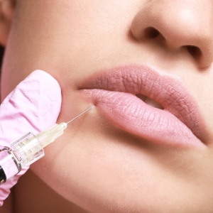 Nahaufnahme einer Lippenunterspritzung mit Hyaluronsäure – ästhetische Behandlung zur Volumensteigerung und Konturverbesserung.